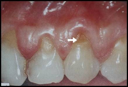 dents erosion acide